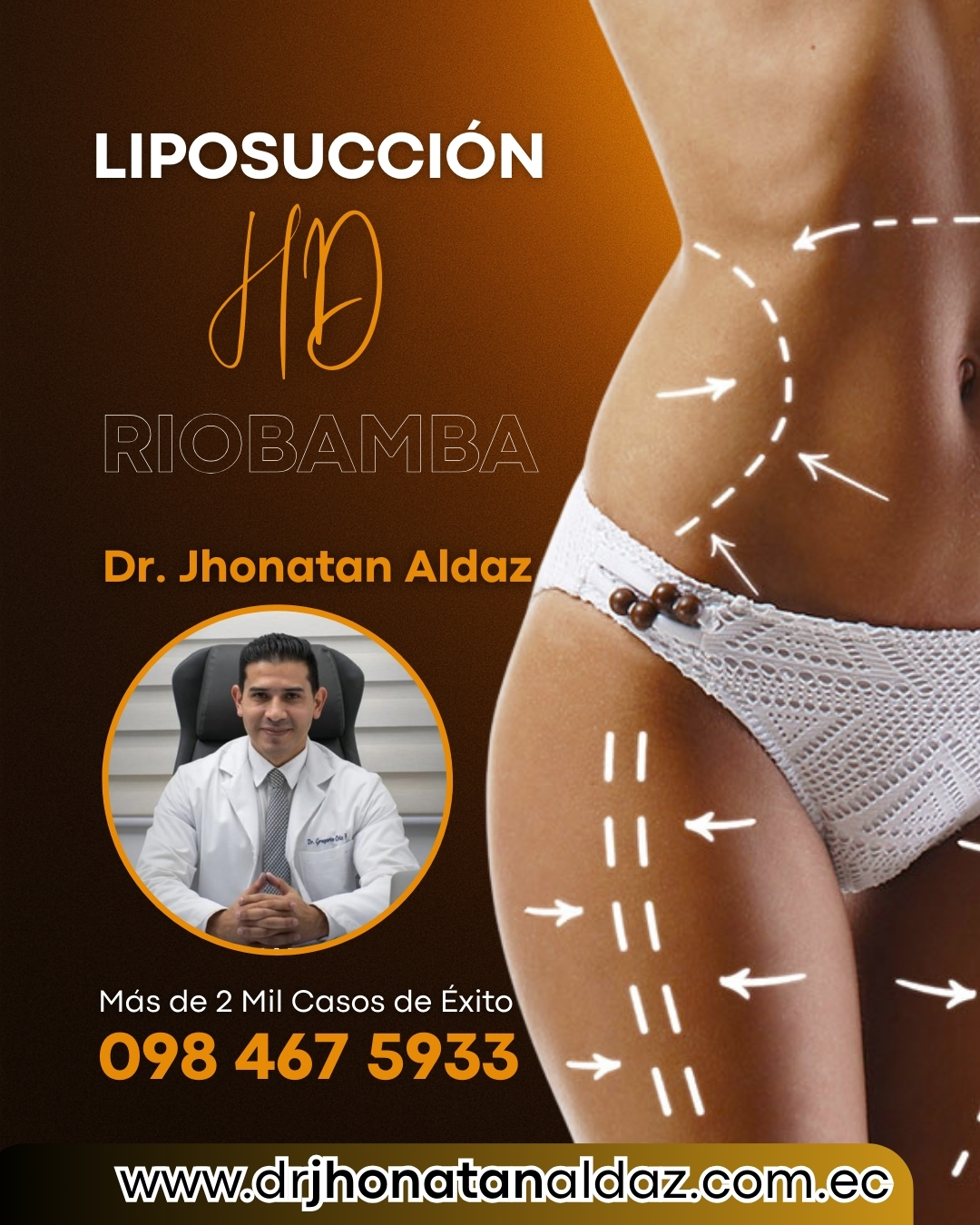 Dr. Jhonatan Aldaz:Cirujano Pl&aacute;stico en Riobamba: Liposucci&oacute;n HD en Riobamba